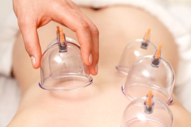 Cupping therapy Vacuum cups of medical cupping therapy on woman back, close up, chinese medicine.